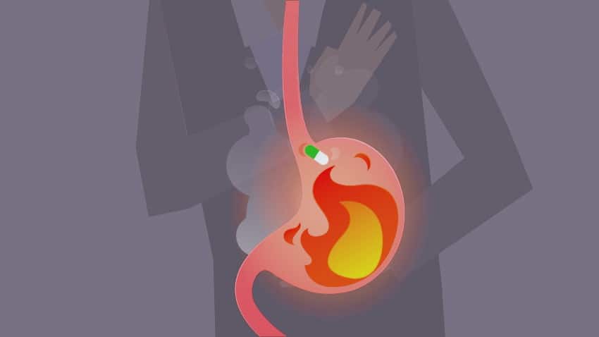 Изжога в пищеводе и желудке. Кислотный рефлюкс это изжога. Гастроэзофагеальная рефлюксная болезнь у беременных. Изжога картинки.